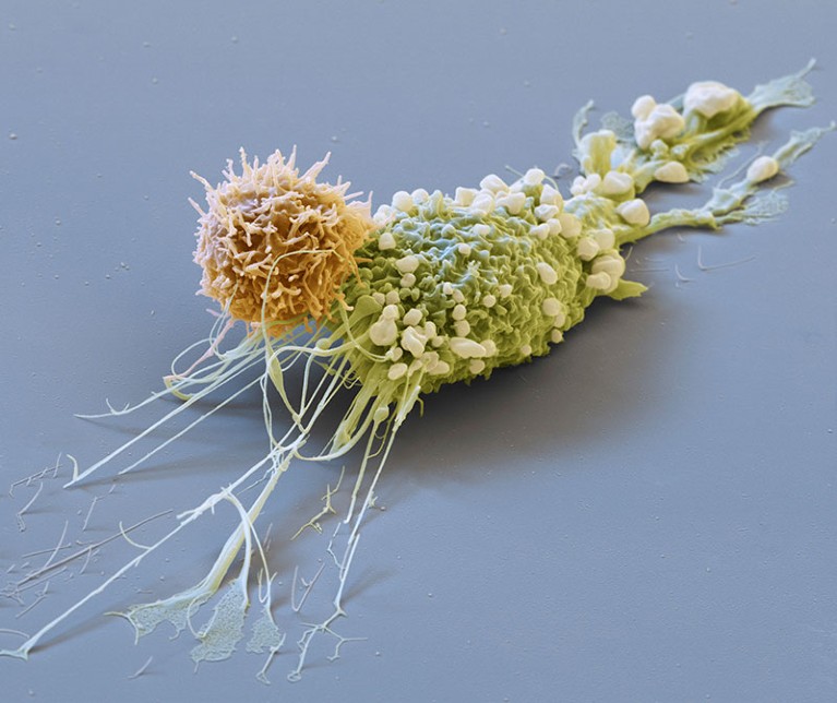 乳腺癌细胞（绿色）被嵌合抗原受体T细胞（橙色）攻击的彩色扫描电子显微照片。